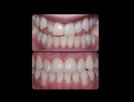Full Braces and oral surgery