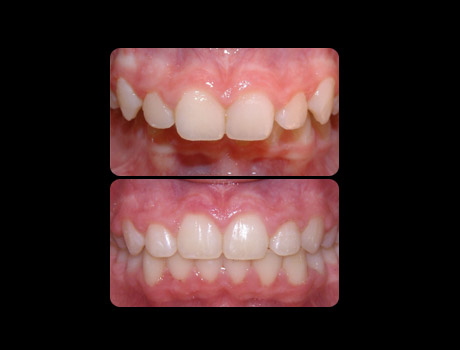 Overjet resolved in 25 months with full upper and lower braces